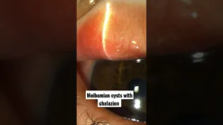 Meibomian cysts with Chalazion