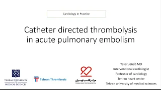 Catheter directed thrombolysis (CDT) in acute pulmonary embolism