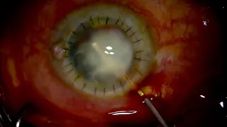 Endophthalmitis caused by Fusarium solani keratitis