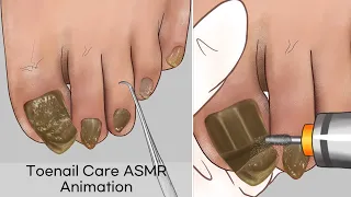 ASMR 10년 묵은 무좀발톱 케어 애니메이션❗️ Most satisfying Athlete's foot Treatment Animation, Tinea unguium