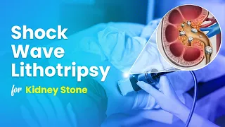Shock Wave Lithotripsy (ESWL) for Kidney Stone Treatment - 3D Guide