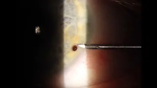 Corneal foreign body removal