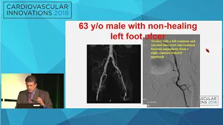 CVI2018 Session: When to use US, CTA or MRA before going to the cath lab - Constantino Pena, MD