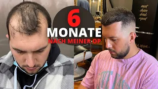 Haartransplantation Vorher Nachher - 6 Monate nach der OP