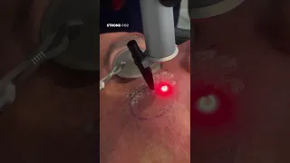 THIS Acne Scar Combination Treatment Works! 👀 (TCA/Subcision/CO2 Laser/Erbium Laser)