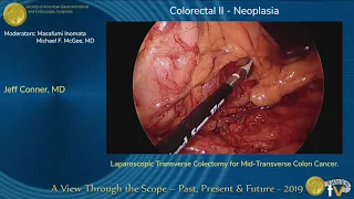 Laparoscopic Transverse Colectomy for Mid-Transverse Colon Cancer