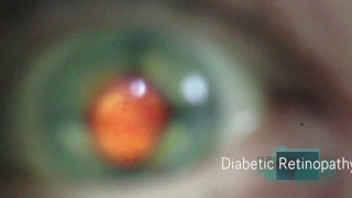 Papilloedema and DR recorded with D-EYE