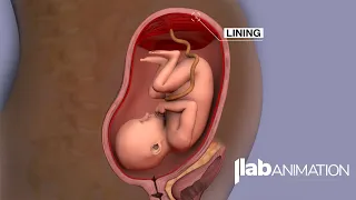 Placenta Accreta