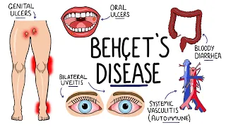 Behcets Disease - Signs and Symptoms (with Triad) | Pathophysiology | Criteria & Treatment