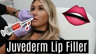 LIP FILLERS Before and After (Live footage) | MY EXPERIENCE | Tara Henderson