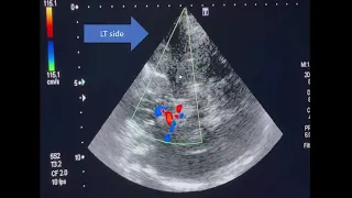 A very simple way to diagnose acute ischemic stroke by TCCD