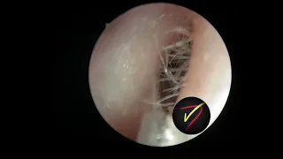 Hole in One Earwax Removal!