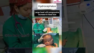 Newborn with hydrocephalus | the baby doctor #newborn #babyvideos #hydrocephalus #ytshortsviral