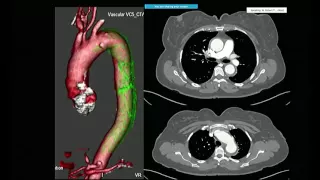 Emory Cardiology Grand Rounds 05-23-2016