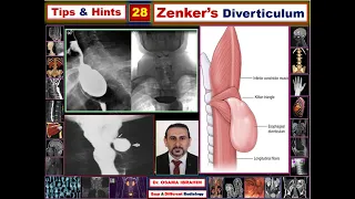 Tips & Hints 28 Zenker's Diverticulum