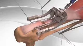 Achilles Tendon Rupture Repair with Arthrex® PARS System