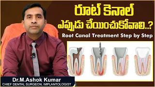Are Root Canals Necessary? | Root Canal Treatment Step by Step in Telugu | Eledent Dental Hospitals