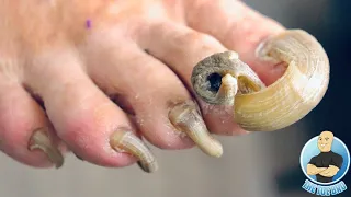 TRIMMING OF EXTREMELY THICK RAM’S HORN TOENAILS ***NOT CLICK BAIT***