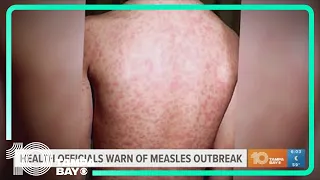 Florida health officials warn of measles outbreak