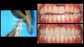ExoCad Orthodontic Set up - Non Surgical Treatment of Anterior Open Bite