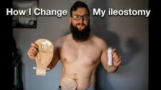 How to change an ileostomy Stoma bag | Tips and Tricks