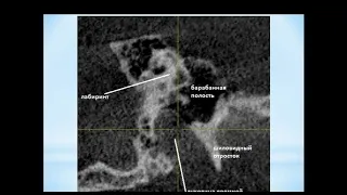 Зубарева А.А.  « КЛКТ в оценке  особенностей анатомического строения височных костей».