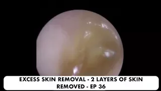 EXCESS SKIN REMOVAL - 2 LAYERS OF SKIN REMOVED EP 36
