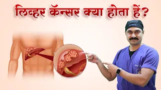 क्या Liver Cancer को ठीक कर सकते है? Liver Cancer Treatment ? Dr.Bipin Vibhute | Hindi