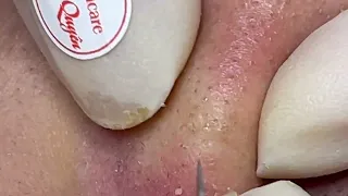 |536| Blackheads & Acne treatment 01/01/2023