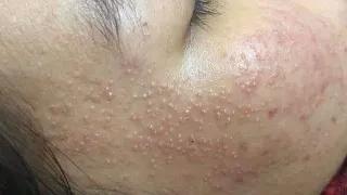 Acne Treament Under The Skin #047