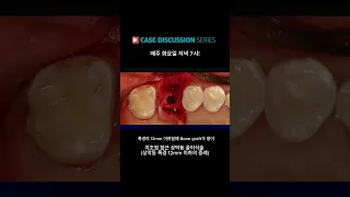 [메가젠] case discussion 윤정훈 원장 / 비후도 및 폭경에 따른 수술전략!