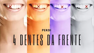 PERDI QUATRO DENTES DA FRENTE - TRATAMENTO COM IMPLANTES DENTÁRIOS