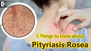 5 Things to know about Pityriasis Rosea | Pityriasis Rosea Rash - Dr. Divya Sharma|Doctors' Circle