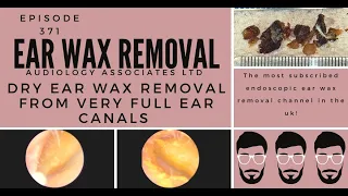 DRY EAR WAX REMOVAL FROM VERY FULL EAR CANALS   EP 371