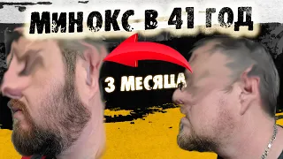 Миноксидил запустил рост бороды в 41 год. Андрей Борода Выпуск №28 Результаты до и после