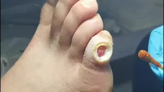 Pedicure : Warts on the toe. How to treat plantar wart. Plantar wart removal. Wart treatment.