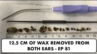 12.5 CM OF EAR WAX REMOVED FROM BOTH EARS - EP 81