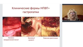 Выбор ИПП для лечения кислотозависимых заболеваний в условиях новой коронавирусной инфекции.