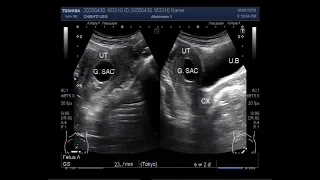 Ultrasound Video showing an empty Gestational sac in pregnancy of about 6 weeks 2 days.