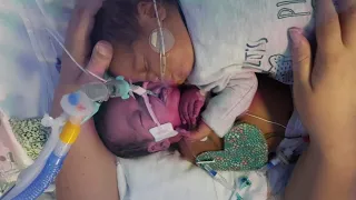 Nurse places a healthy baby next to dying twin and what happened left everyone dumped down