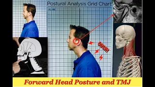 TMJ & Forward Head Posture