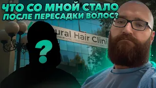 Результат пересадки волос! Что со мной стало после пересадки волос в Узбекистане?