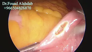 Mini gastric bypass تحوير مسار المعدة المصغر