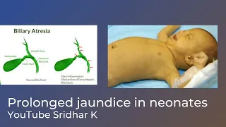 Approach to persistent and prolonged neonatal jaundice. Dr Sridhar Kalyanasundaram