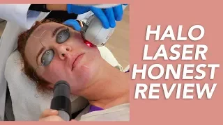 My Halo Laser Experience: Honest Review, Recovery, and Before & Afters!
