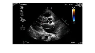 How to diagnose amyloidosis by echocardiography