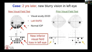 Clinical Presentation and History - Adult patients with ODD and mechanism of vision loss