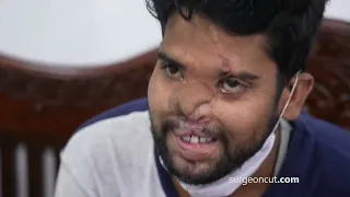 Accident burned his Nose came for Nose reconstruction