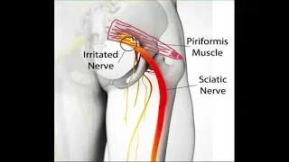 Síndrome do Piriforme Liberação Miofascial DOR CIÁTICA - Clínica de Fisioterapia Dr. Robson Sitta