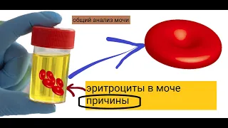 почему повышены эритроциты в моче и что это значит ?